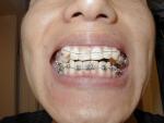 Before and after braces 歯の矯正の前後